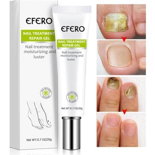 20g Fungal Nail Treatment Cream Nail Foot Nail Fungus Infection Onychomycosis Gel Cream Anti Care Repair Removal Essence Na L7J2