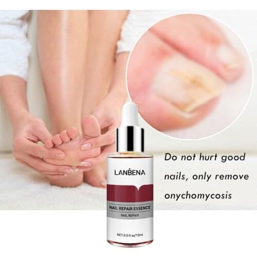 15ml Fungal Nail Repair Serum Fungus Removal Gel Anti Paronychia Onychomycosis Stimulate Nails Health Growth Care Foot Nail Tool