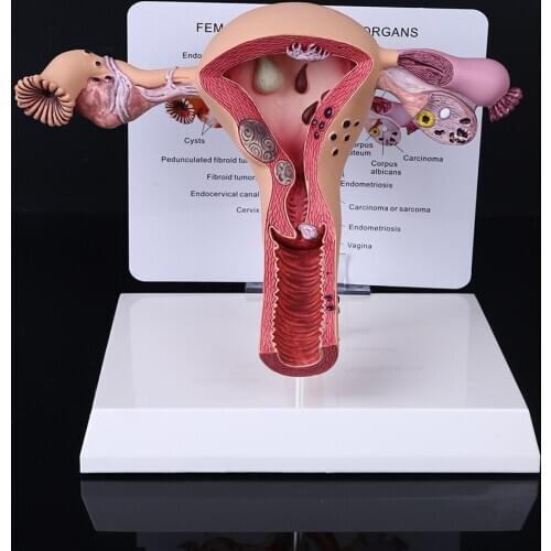 High Quality Human Female Uterus Ovary Disease Dissection Pathology Model Biology Teaching Aids Anatomy Lesion Uterus
