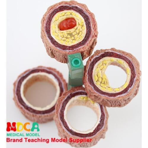 Vessel anatomy, atherosclerosis, pathology, cardiovascular circulation model medicine teaching MXG001