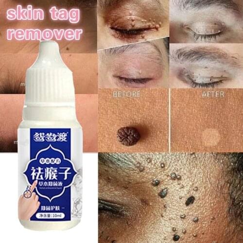 10Ml Skin Tag Remover Genital Warts Treatment Instant Papillomas Corn Foot Repair Tool Natural & Liqu Bacteriostatic Remove P0H2