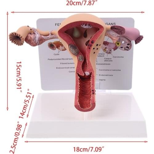 2021 New Human Female Uterus Ovary Disease Dissection Pathology Model Biology Teaching