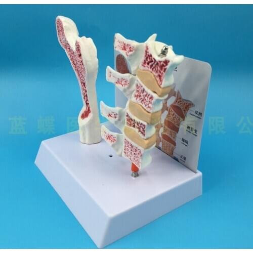 4D Human femur osteoporosis anatomical model leg bone surface spine section specimens diseased lumbar spine model