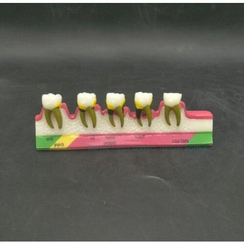 Dental Periodontal Disease Assort Tooth Typodont Model