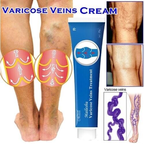 Spider Varicose Veins Cream Varicose Veins Ointment Natural Treatment For Relief Phlebitis Angiitis Leg Smearing Cream Remedies