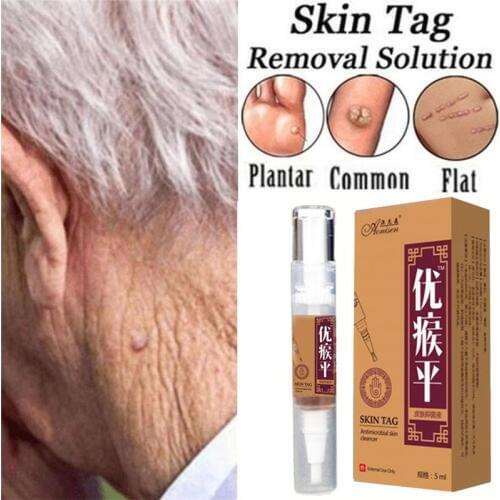 Skin Tag Remover Pen 12 hours Tu kill Medical Tu kill Remover Skin Tag Mole & Genital Wart Remover Foot Corn Removal Pen
