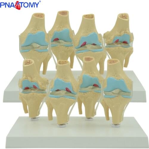 Four sets human knee model normal and abnormal knee joints model medical teaching tool skeleton anatomy