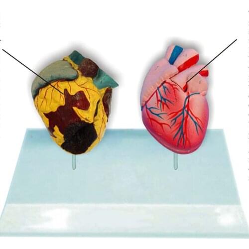 Smoking heart vs normal heart comparison model heart anatomy model medical teaching model