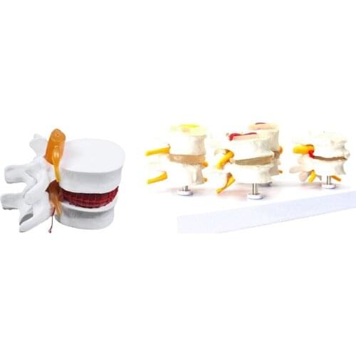 1 Pcs Skeleton Spine Lumbar Disc Herniation Teaching Model & 1 Pcs Human Anatomy Skeleton Spine Vertebral Model