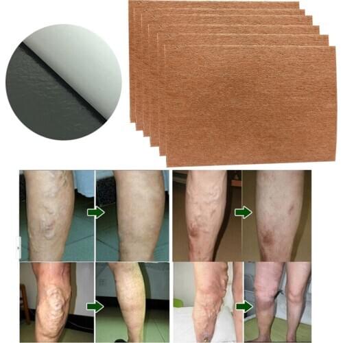 9 Pcs Spider Veins Varicose Treatment Plaster Varicose Veins Cure Patch Vasculitis Natural Solution Herbal Patches
