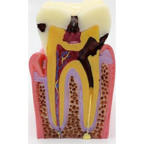 NEW Denture Teeth model 6X, caries comparison model, tooth decay model,Dentist for Medical Science Teaching