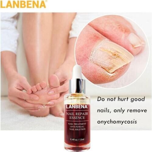LANBENA Fungal Nail Treatment Bright Nail Repair Liquid Onychomycosis Essence 50%OFF Nail Repair Essence T0923
