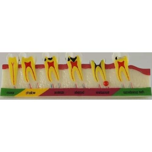 Dental Caries classification model Caries Developing Model