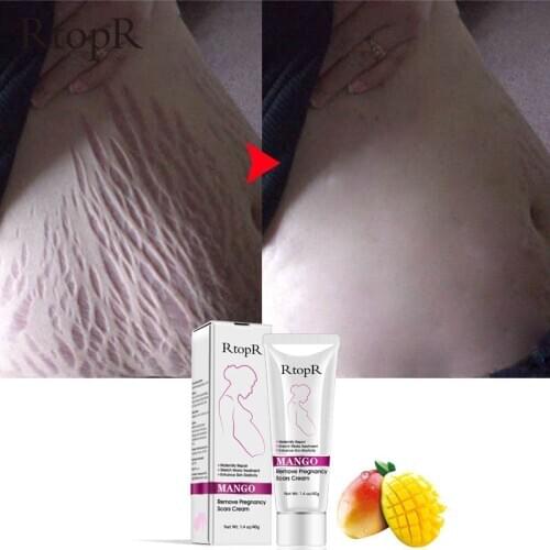 Mild Non-irritating Mango Stretch Mark Cream For Pregnancy Repair Scar Slack Line Abdomen Stretch Body Cream