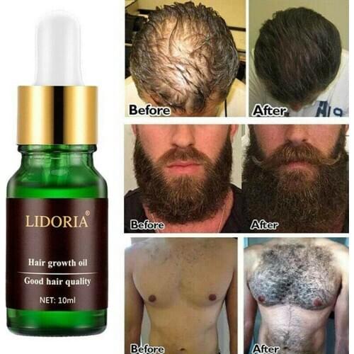 10ml Hair Growth Essential Ginger Oil Hair Loss Baldness Treatment For Men Women