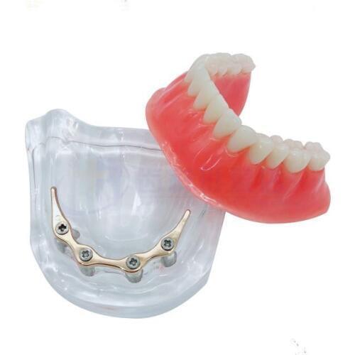 6pcs /pack Dental Teaching Model Overdenture implant model Denture Teeth mandibular model with golden bar