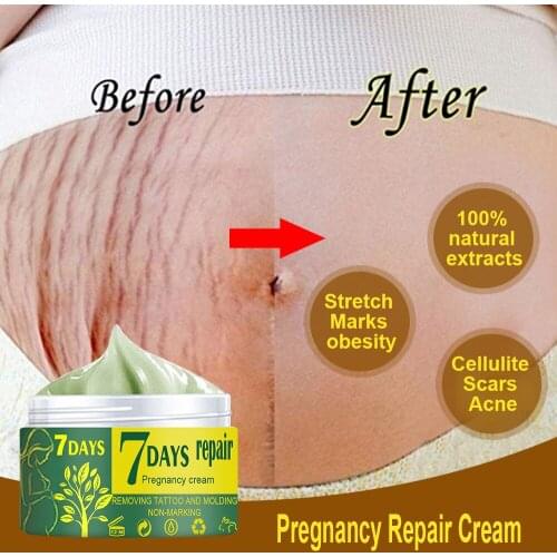 10/30/50g Pregnancy Stretch Mark Repair Cream Maternity Obesity Skin Postpartum Stretch Scar Body Marks Remover Smooth Skin Care