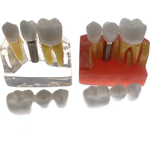 1 PC 4-times Planting Teeth Model Oral Teaching Model Dental Pathology Model For Dentistry Lab