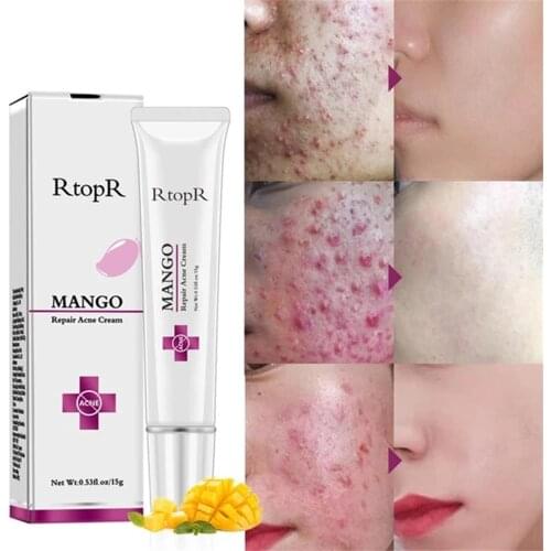 Acne Treatment Face Cream Acne Remover Creams Gel Oil Control Shrink Pores Scar Removal Anti Acne Skin Care Korean Cosmetics