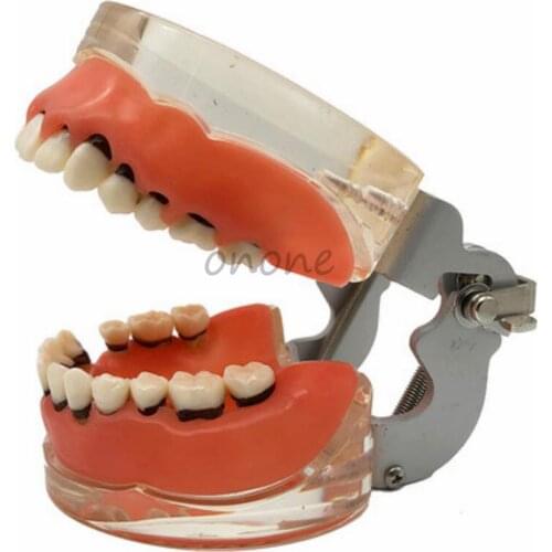 1pcs Periodontal Pathological Model Practice Supragingival Subgingival Scaling Calculus Model Student Learning Teaching Model