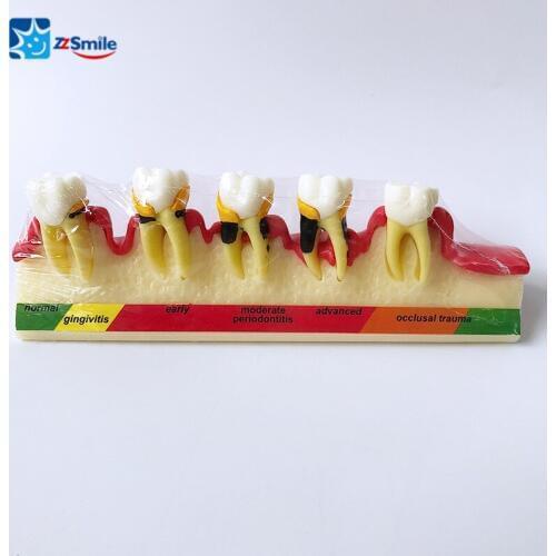 M4010 Dental Periodontal Disease Model For Demonstration