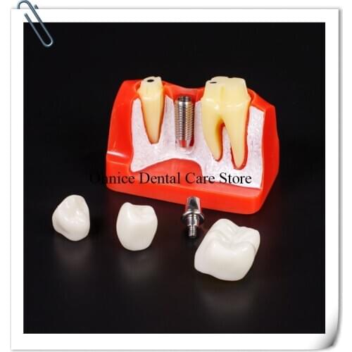 Dental Implant Teeth Model M2017 with Fixtures and crown/Dental Tooth Model shows Impalnt Analysis