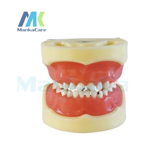 Manka Care - Caries model of child/Gum can be removed Oral Model Teeth Tooth Model