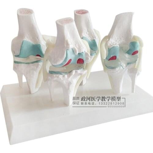Knee joint pathology model Lesion knee degenerative knee joint Arthroscopic surgery model