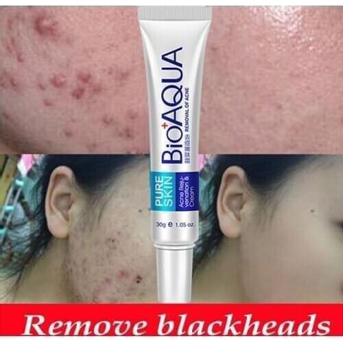 5Pcs/Set Acne Treatment Blackhead Remova Anti Acne Cream Oil Control Shrink Pores Acne Scar Remove Face Care Whitening Cream