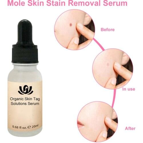 3PCS 20ml Vitamin C Essence Painless Mole Skin Stain Removal Serum Whitening Facial Firming Repair Essence Face Skin Care