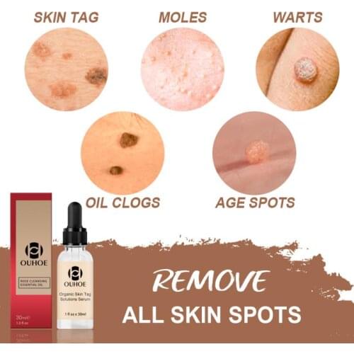 30ml Painless Mole Skin Dark Spot Removal Face Wart Tag Freckle Removal Cream Oil Plaster Face Mole Skin Serum Removal Solution