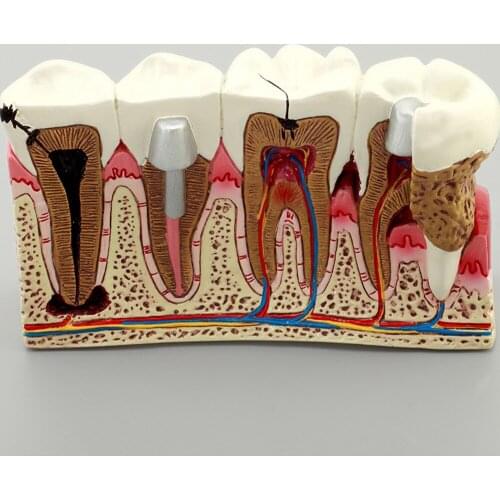 Dental Implant Teeth Model M4029/Dental Pathologies Caries Tooth Model/Dental Pathologies Education study teeth Model