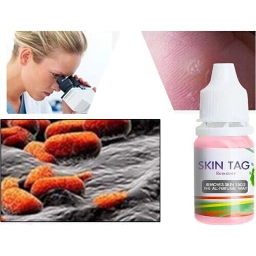 10ml Skin Tag Remover Liquid Foot Corn Plantar Body Warts Treatment Ointment MOLF
