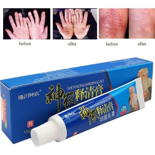 Profession Cure Psoriasis Ointment Skin Pruritus Peeling Blisters Mosquito Bites Skin Infections Antibacterial Herbal Cream