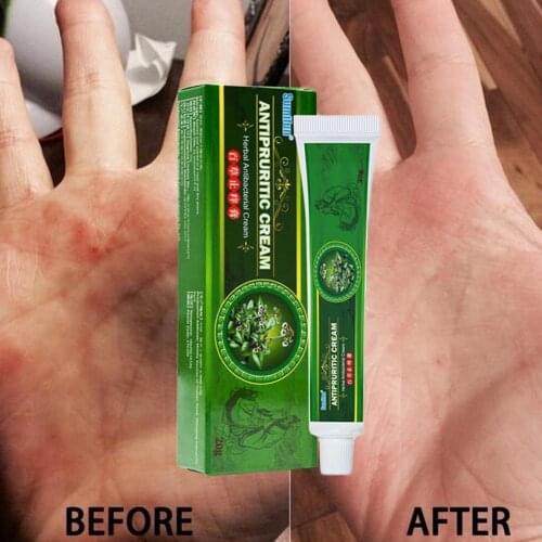 20g Eczema Ointment Psoriasis Cream Anti Itching Pruritus Dermatitis Pain Care Skin Herbal Plaster Medical Chinese Patch D9V7