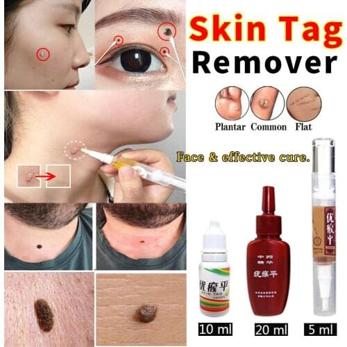 Effective Skin Tag Remover Medical Fast Removal Mole &Genital Anti Wart Bacteriostatic Wart Foot Corn Treatment Kit Skin Care