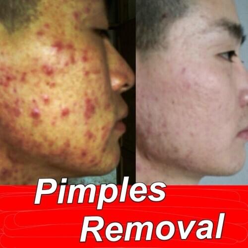 Chinese Medicine Pimple Pimples Removal Acne Blackheads Remove Cream High Quality Free Shipping