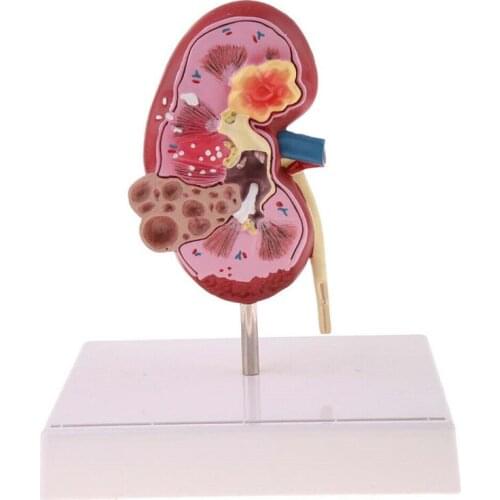 Diseased Kidney Model Human Anatomical Medical Pathological Changes Specimen For Patient Education Teaching Medical Supplies