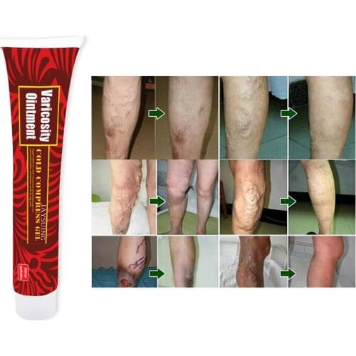 New Varicose Veins Treatment Cream 100% Original Vasculitis Phlebitis Spider Pain Relief Ointment Medical Plaster