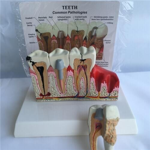 Human Tooth Common Pathologies Anatomy Model Dental Model Medicine Teaching Instrument
