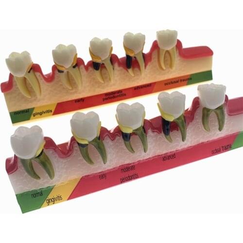 Dentist Odontologia Periodontal Disease Dental Teeth Model Tooth dental Model
