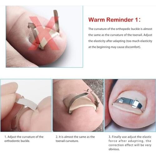 5 Sizes Ingegroeide Teen Nail Correctie Tool Teennagel Rechttrekken Correctoren Patch Tool Rechttrekken Clip Brace Pedicure Tool