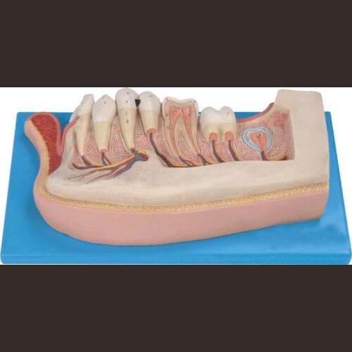 Import 3 Times Magnification Children Tooth Model Child Teeth Anatomical Model Caries Dental Teeth Pathology Model Medical Aids