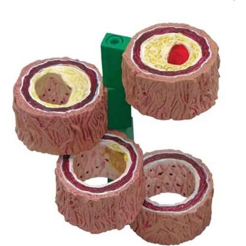 Stage 4 is suitable for cardiovascular porridgeization of coronary heart disease in arterial models