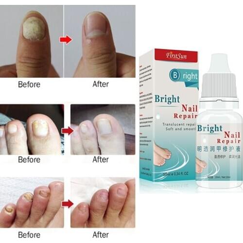 Fungal Nail Treatment Repair Liquid Foot Whitening Nail Repair Fungus Removal Gel Anti Infection Toe Onychomycosis Remover TSLM1