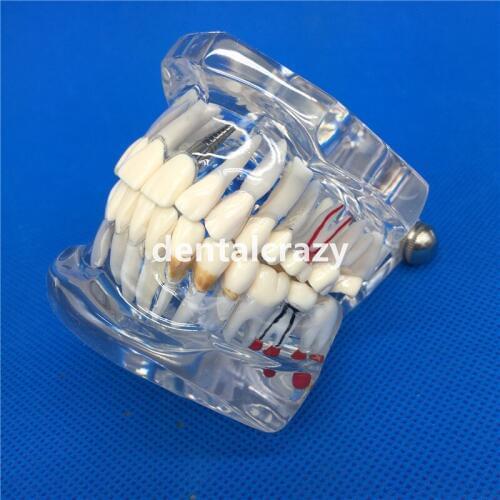 Dental Implant Disease Teeth Model With Restoration Bridge Tooth Dentist For teaching high quality