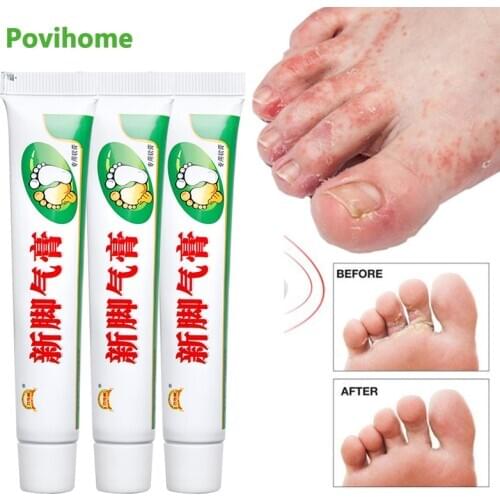 1/3Pcs Foot Cream Foot Corn Removal Athletes Erosive Beriberi Anti Itching Sweat Odor Feet Psoriasis Antibacterial Ointment