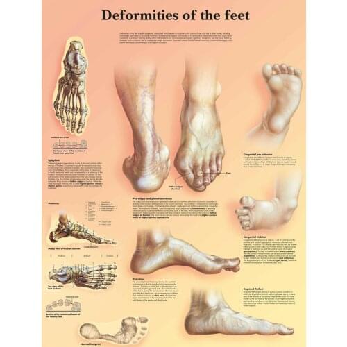 Deformities of the Human Feet Picture Art print Silk poster Home Wall Decor