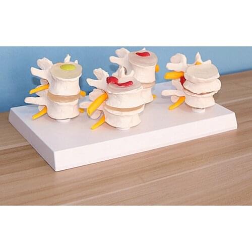 Medical Human Anatomy Skeleton Spine 4-stages Lumbar Vertebrae Model Human Lumbar Lesion Spinal Statue Display Model