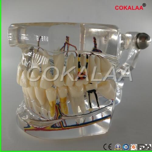 Dental implant teeth model with nerve Transparent pathological Repair model Teaching demonstration teeth model